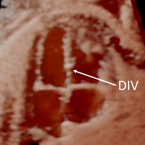 Ecocardiografia fetale 3D