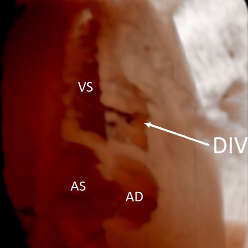 Ecocardiografia fetale 3D