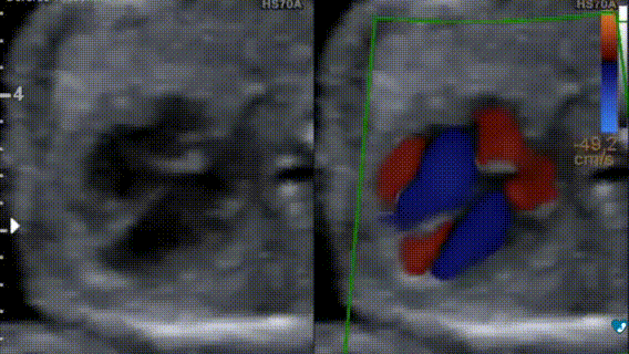 Ecocardiografia fetale - 17 settimane