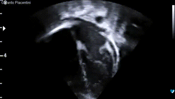 Ecocardiografia pediatrica – Proiezione 4 camere