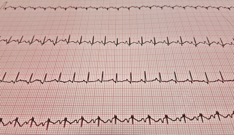 Elettrocardiogramma (ECG)